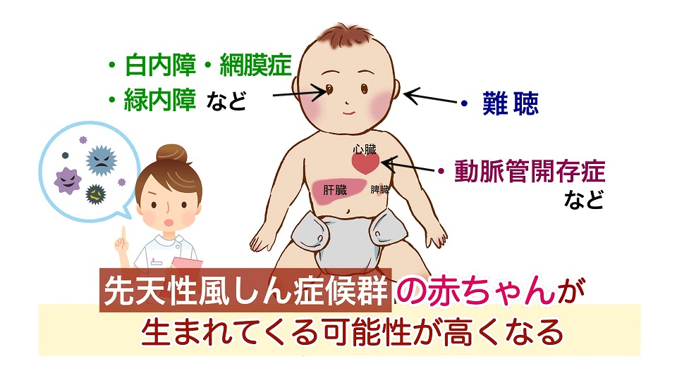 先天性風しん