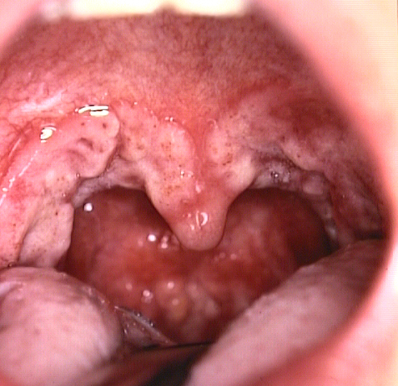 喉の症状写真